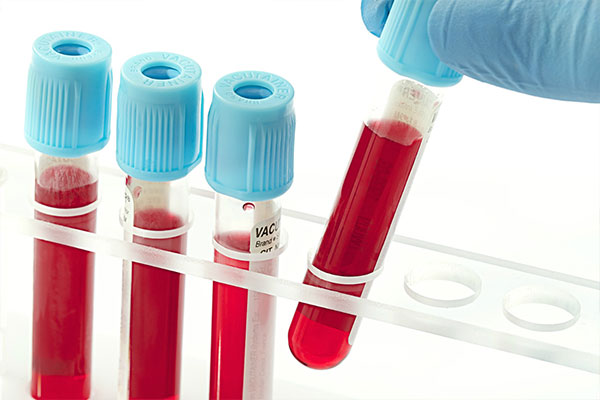 Xét nghiệm sinh hóa máu để nhanh chóng phát hiện có bị sốt xuất huyết hay không